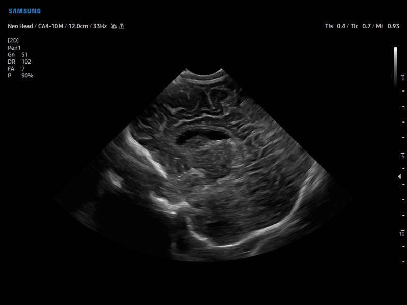 Neonatal head (echogramm №877)