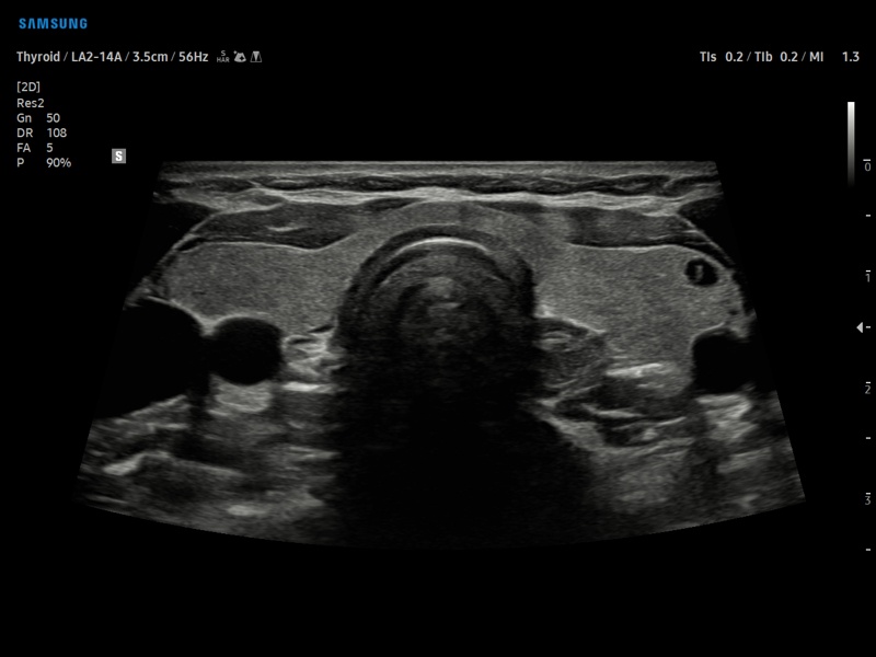 Thyroid, B-mode (echogramm №878)