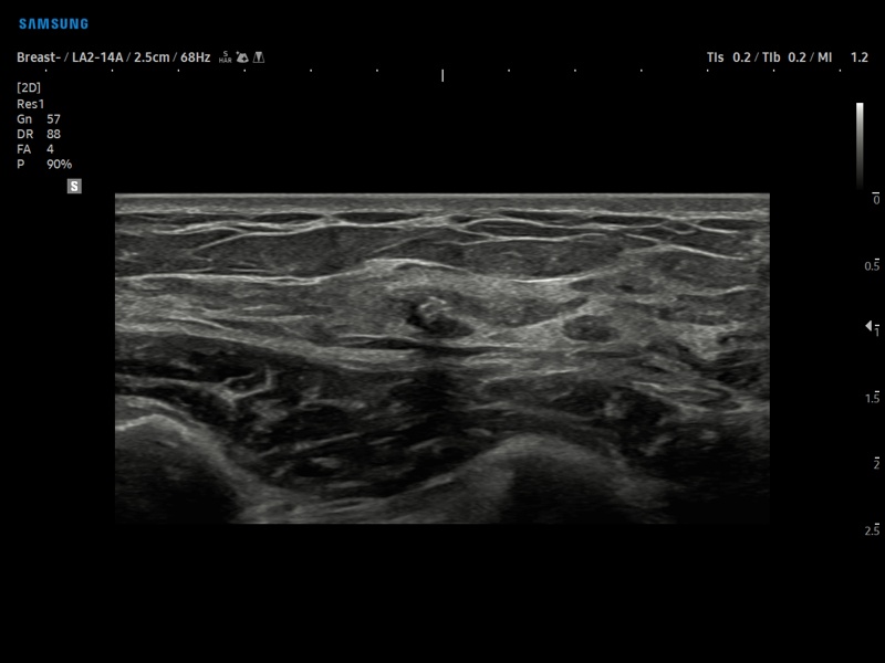 Breast - calcifications (echogramm №879)