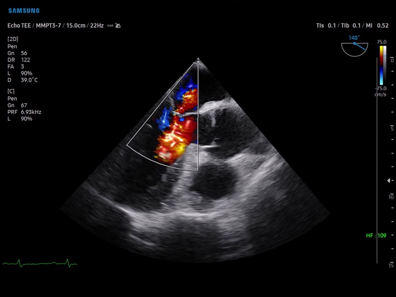 Mitral regurgitation - transesophageal echocardiography (echogramm №880)