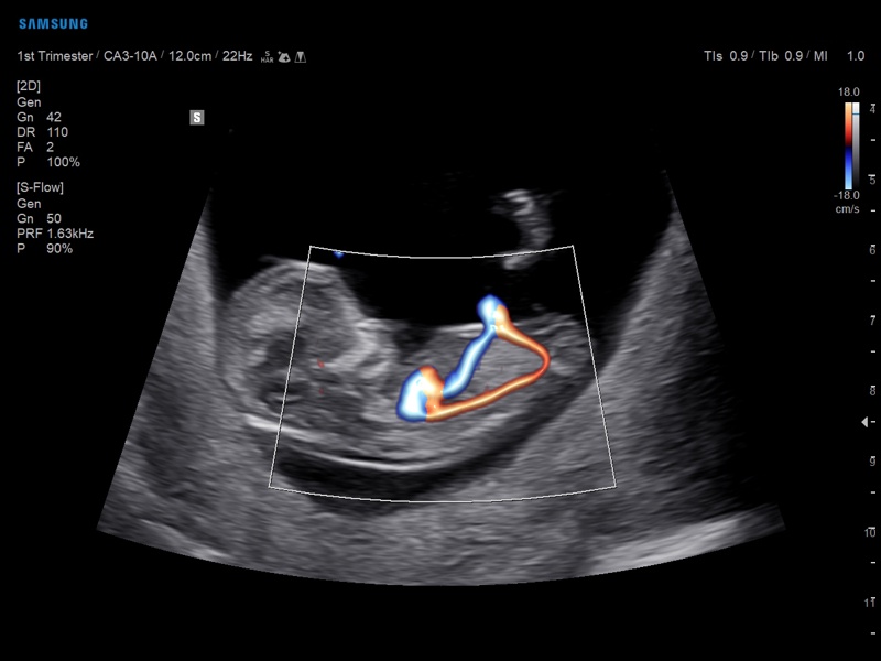 Fetus, S-Flow & LumiFlow (echogramm №883)