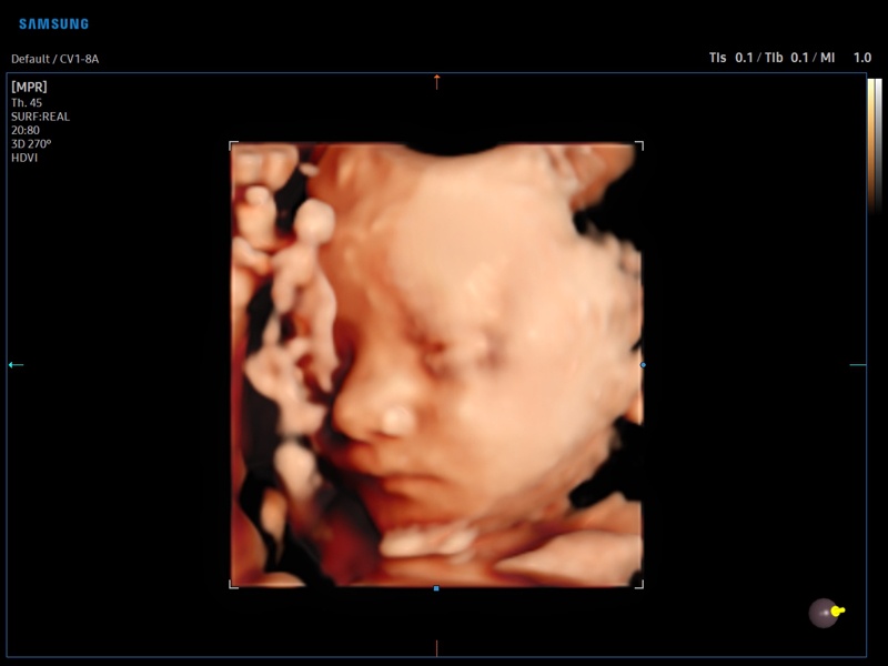 Fetal face, RealisticVue, 3D (echogramm №884)