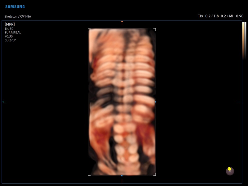 Fetal skeleton, CrystalVue, 3D (echogramm №885)