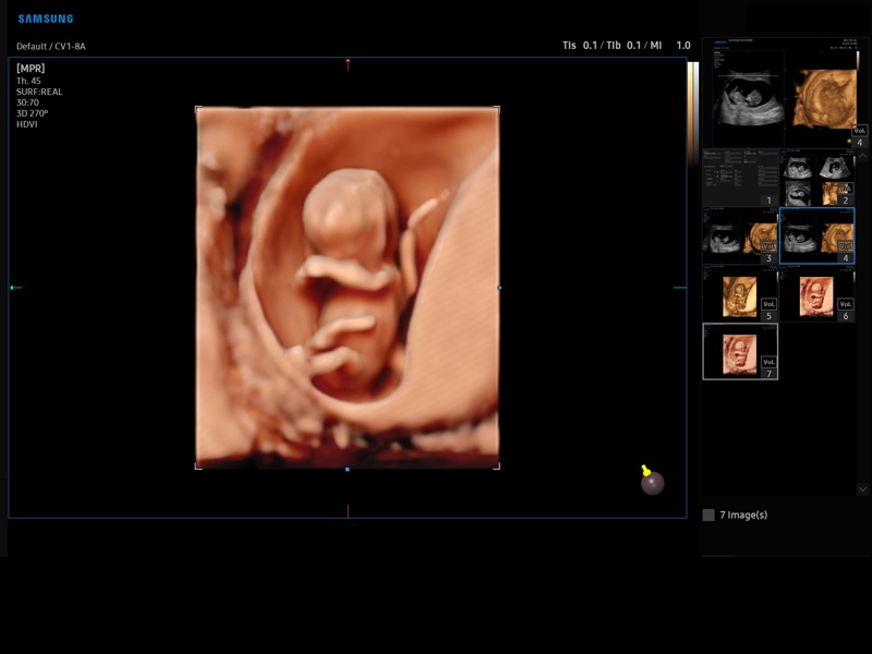 Fetus - early gestation, Realistic Vue, 3D (echogramm №887)