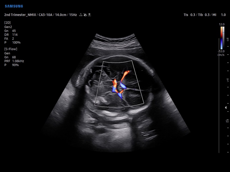 Fetal MCA, S-Flow (echogramm №888)