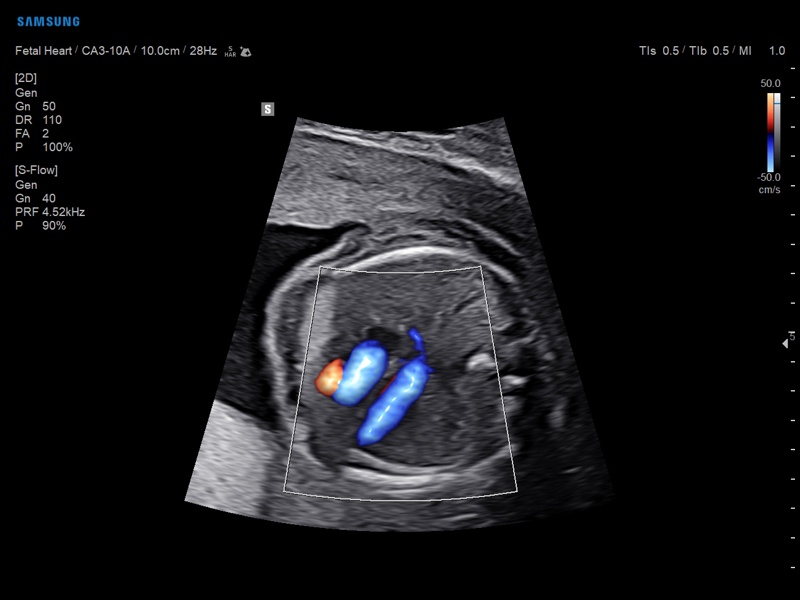 Fetal heart, S-Flow & LumiFlow (echogramm №889)