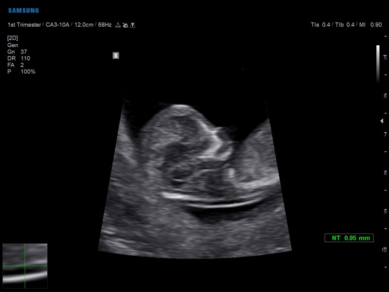 Fetus - NT measurement, BiometryAssist (echogramm №890)