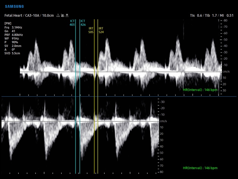 Fetal heart, RV MPI (echogramm №891)