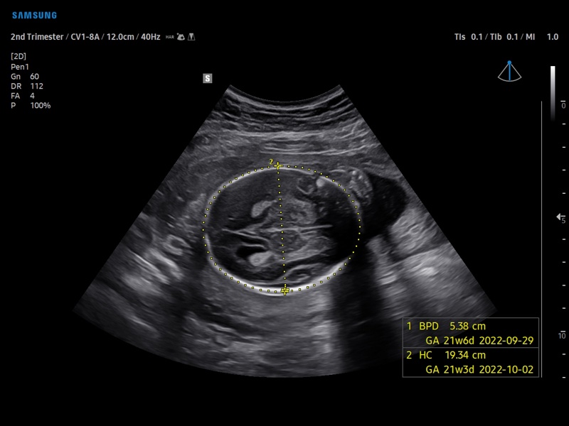 Fetal head, BiometryAssist (echogramm №892)