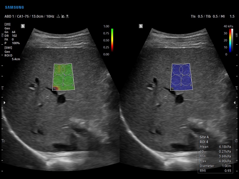 Liver, S-Shearwave (echogramm №894)