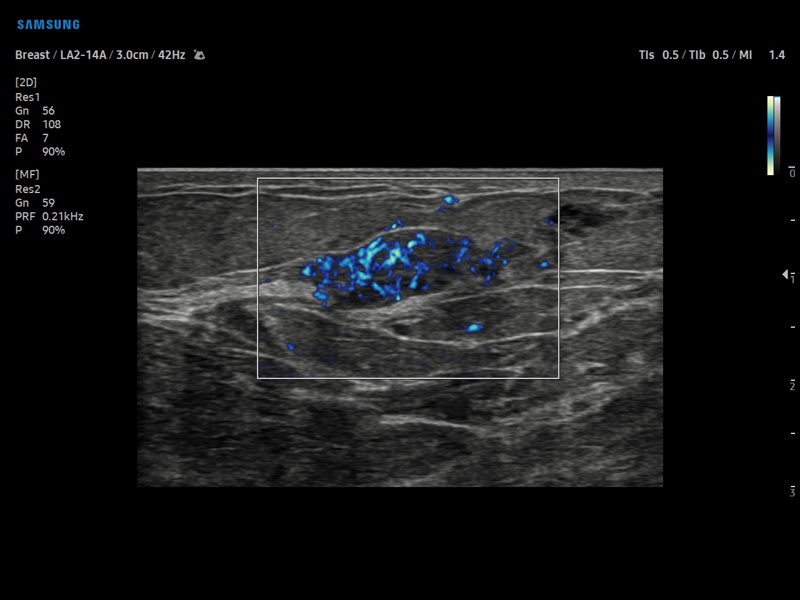 Breast nodule, MV-Flow (echogramm №897)