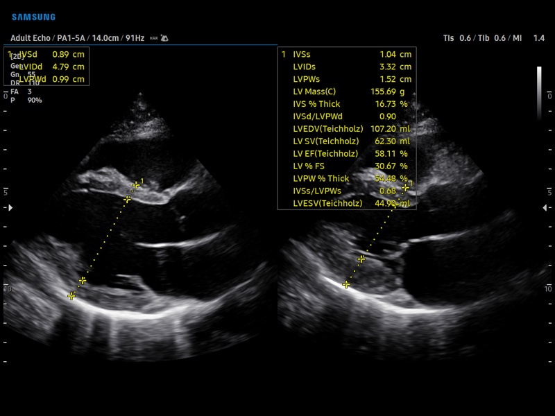 Heart (long axis of LV), B-mode + Assist (echogramm №900)