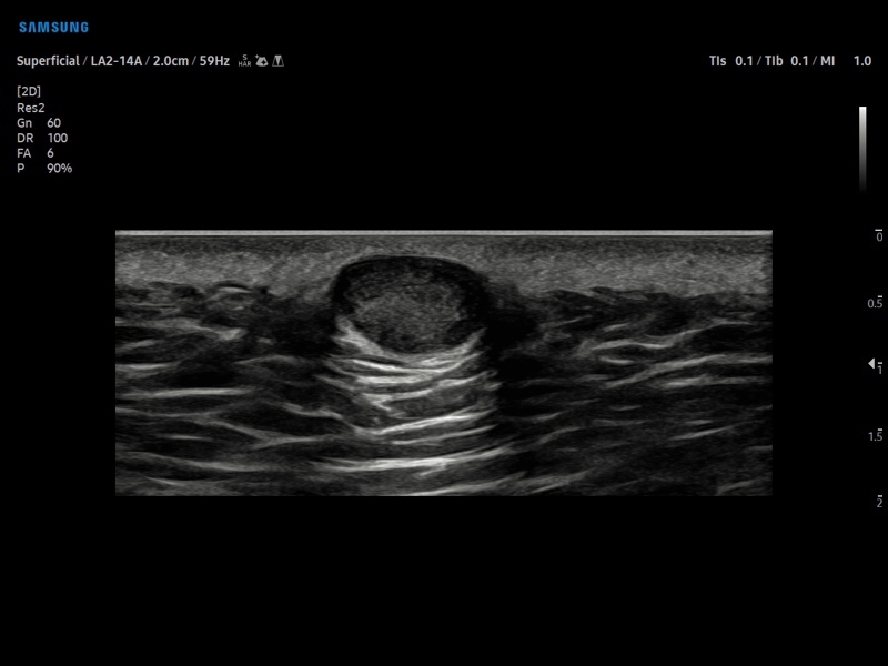 Lipoma, B-mode (echogramm №901)