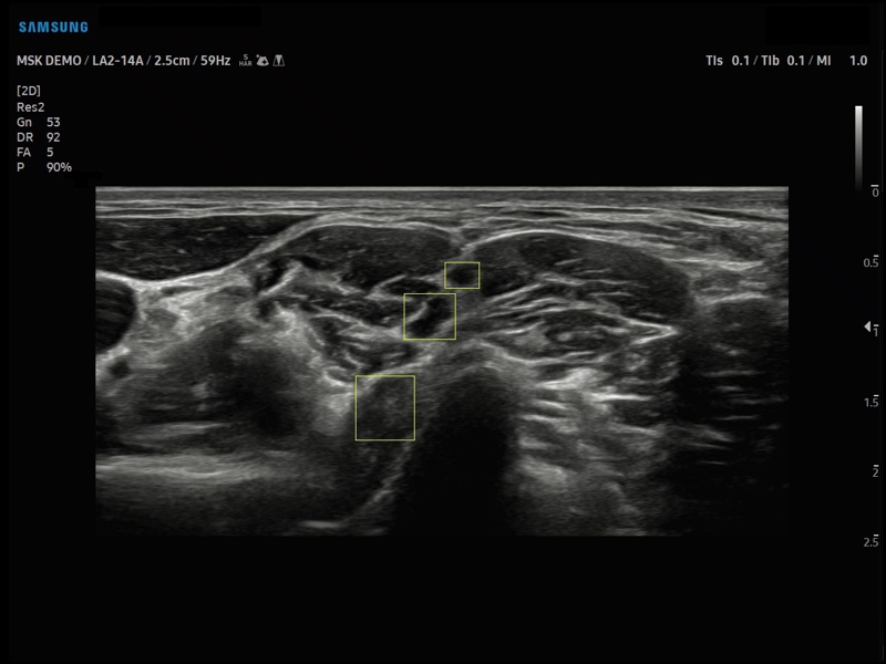 Brachial plexus, Nerve Track (echogramm №902)