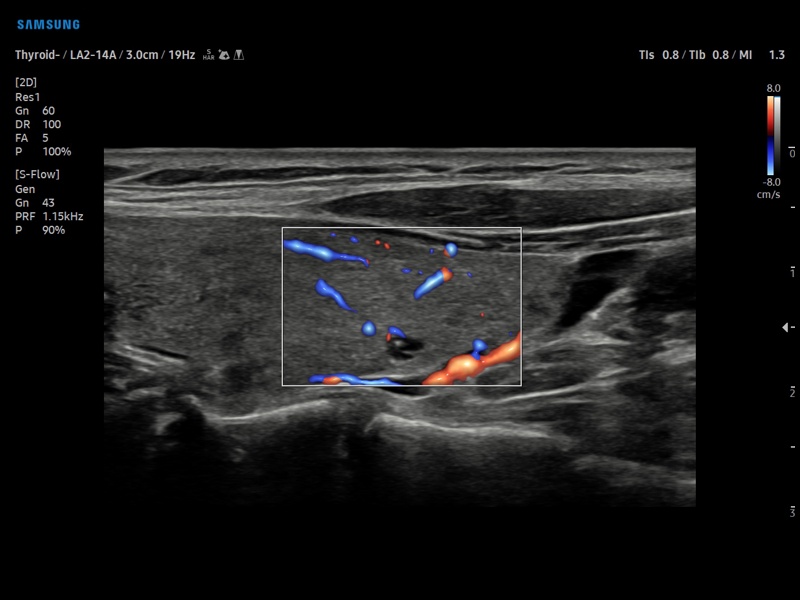 Thyroid, S-Flow (echogramm №905)