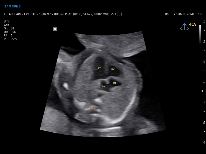 Fetal heart (4 chamber view), ViewAssist (echogramm №906)