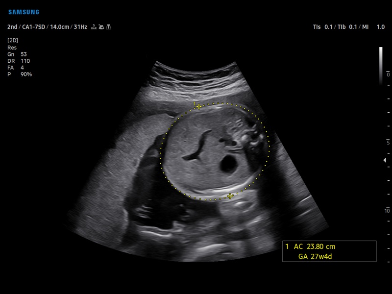 Fetus, BiometryAssist (echogramm №907)