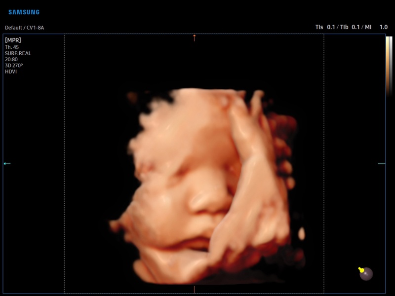 Fetal face, RealisticVue, 3D (echogramm №908)