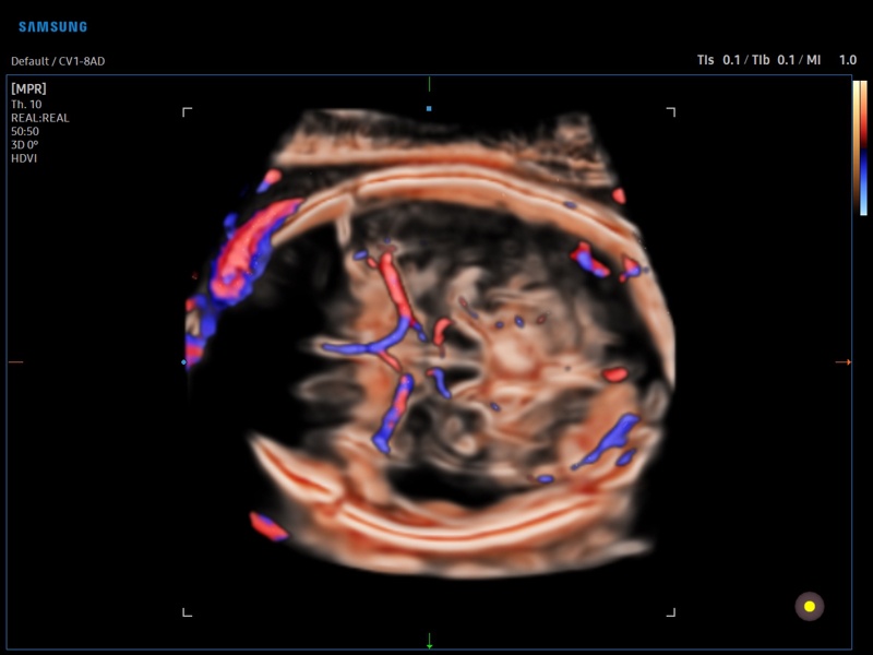 Fetal brain, CrystalVue Flow, 3D (echogramm №909)