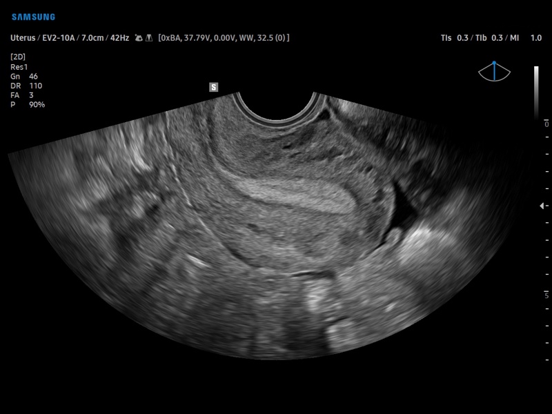 Uterus, B-mode (echogramm №910)