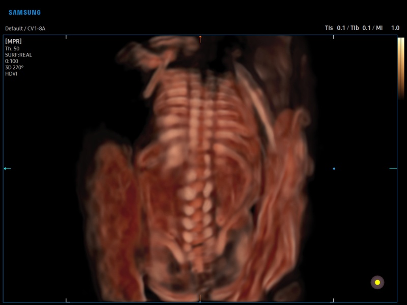 Fetal spine, CrystalVue, 3D (echogramm №911)