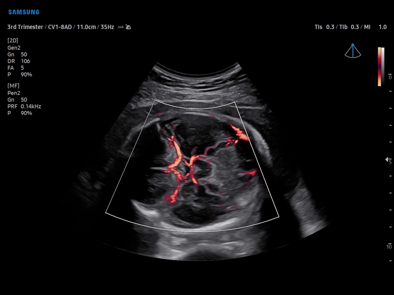 Fetal brain, MV-Flow (echogramm №912)