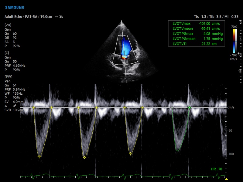 Left ventricular outflow tract, HeartAssist (echogramm №914)