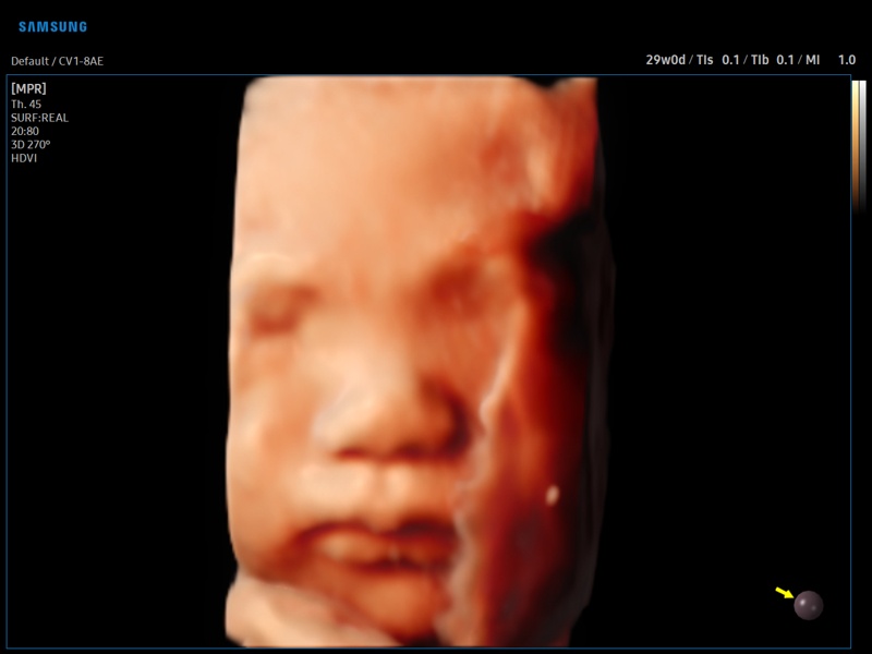 Fetal face, RealisticVue, 3D (echogramm №915)