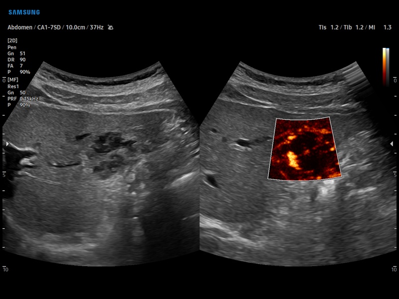 Liver hemangioma, MV-Flow (echogramm №916)