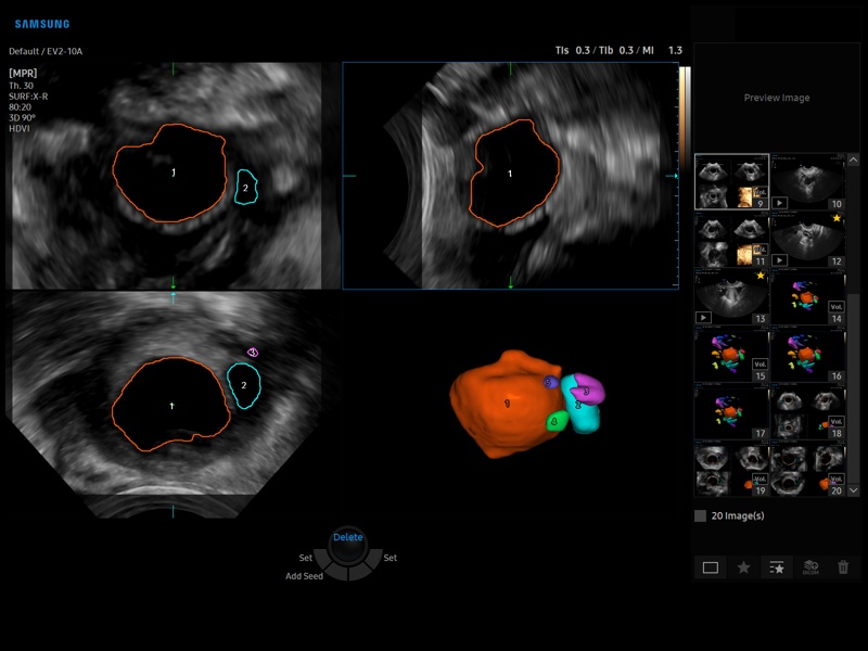 Ovarian Follicles Ultrasound