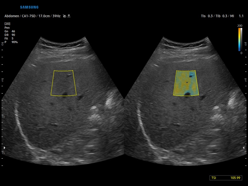 Hepatic steatosis, QUS (TAI+TSI) (echogramm №918)