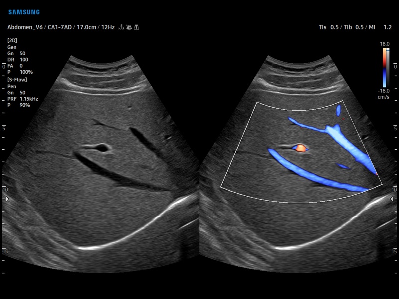 Hepatic vein, S-Flow (echogramm №919)