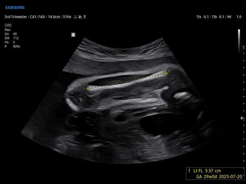 Fetal femur, ViewAssist (echogramm №920)