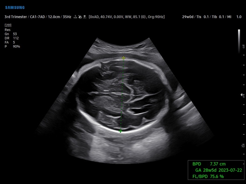 Fetal brain, BiometryAssist (echogramm №921)