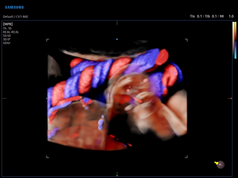 Umbilical cord, CrystalVue Flow (echogramm №922)