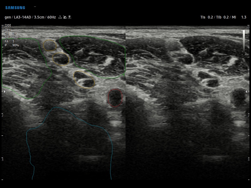 Brachial plexus, NerveTrack (echogramm №924)