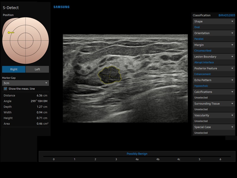 Breast, S-Detect (echogramm №926)