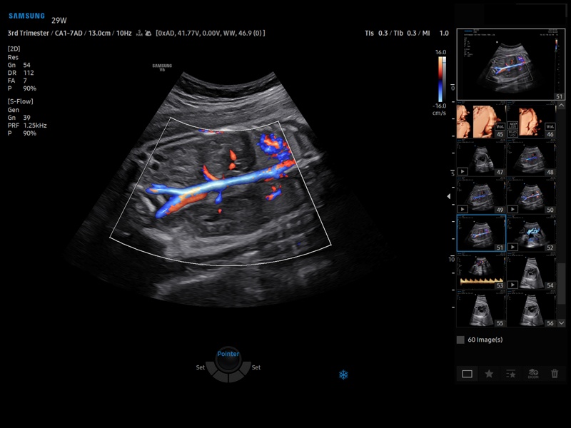 Renal artery, S-Flow & LumiFlow (echogramm №927)