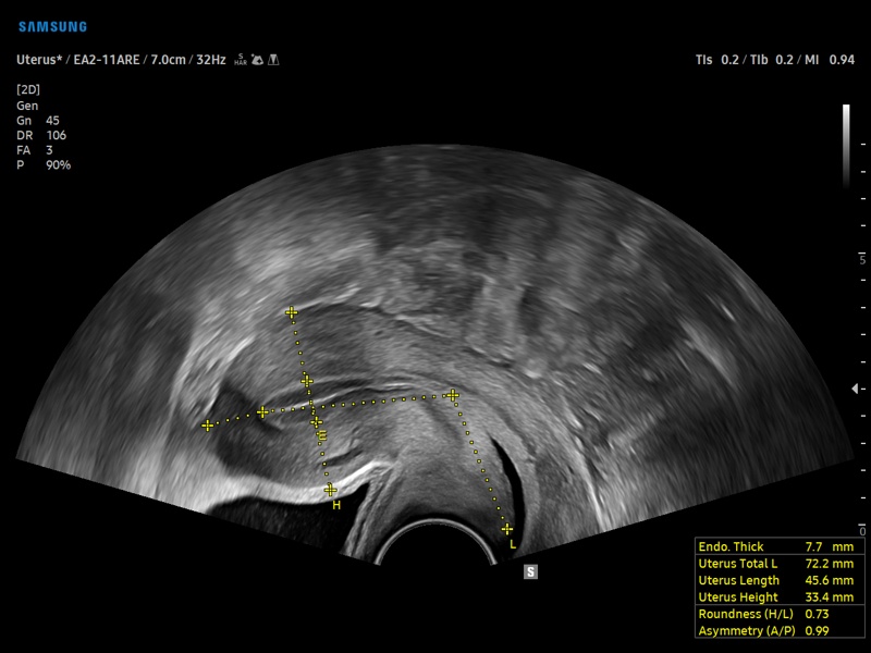 Uterus, UterineAssist (echogramm №929)