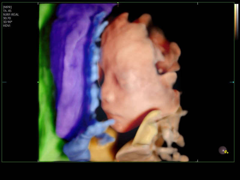Fetus, EzVolume™ (echogramm №931)