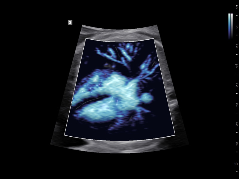 Fetal heart, MV-Flow™ (echogramm №932)