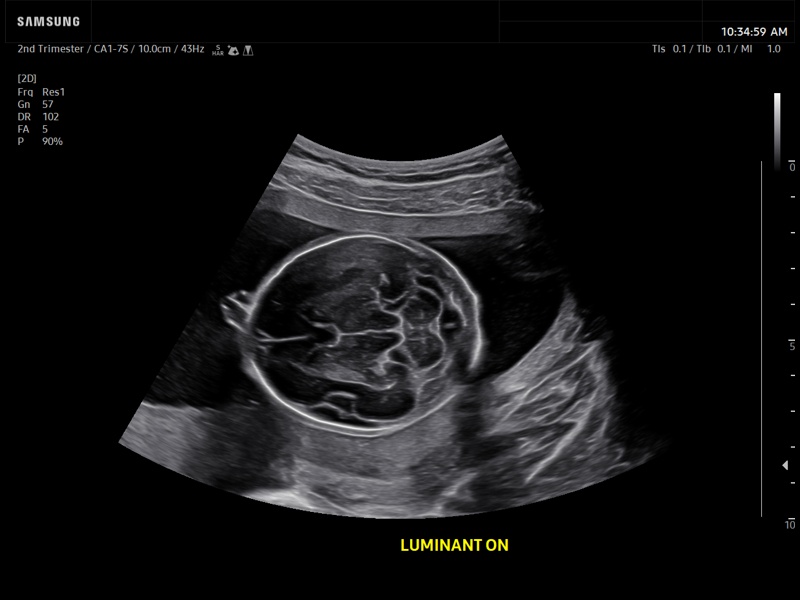 Fetal brain, Luminant™ (echogramm №933)