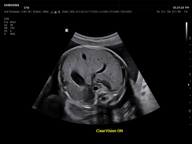 Fetal abdomen, ClearVision (echogramm №934)