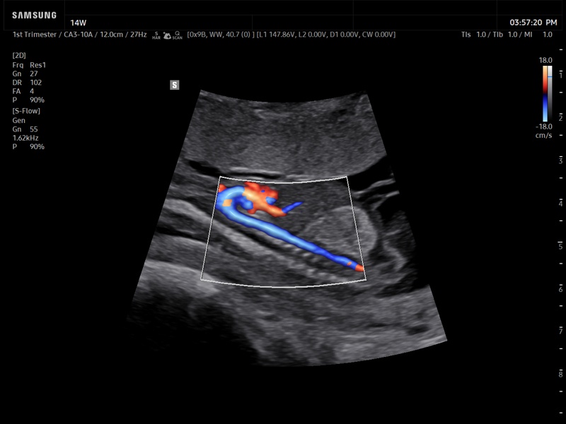 Fetal aorta, S-Flow™ (echogramm №935)