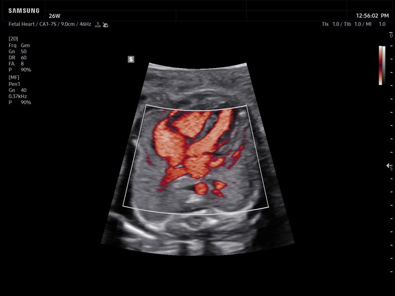 Fetal heart, MV-Flow™ (echogramm №936)