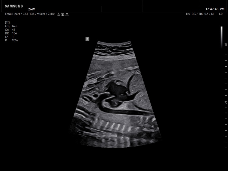 Fetal heart, Luminant™ (echogramm №937)