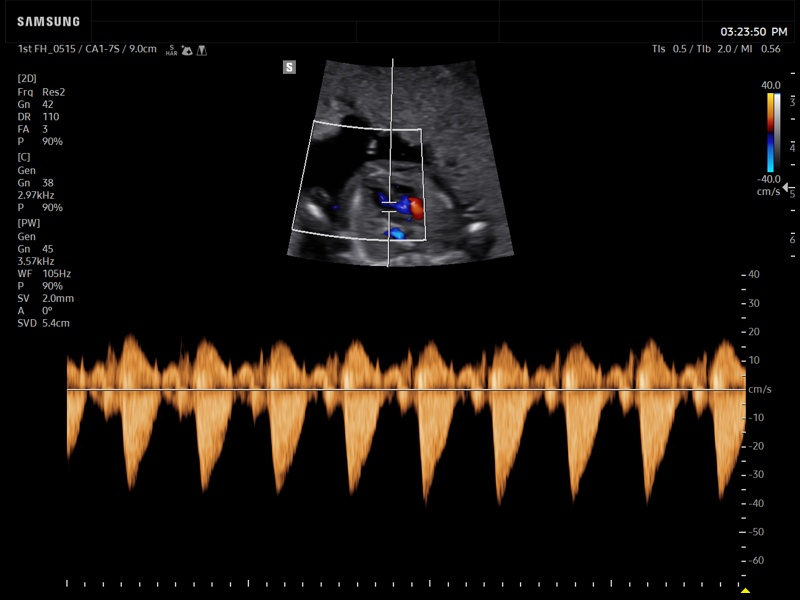 Fetal heart (LVOT), CFM & PW (echogramm №938)
