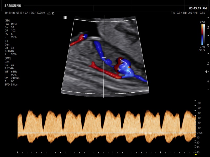 Fetal heart (ductus venosus), CFM & PW (echogramm №939)