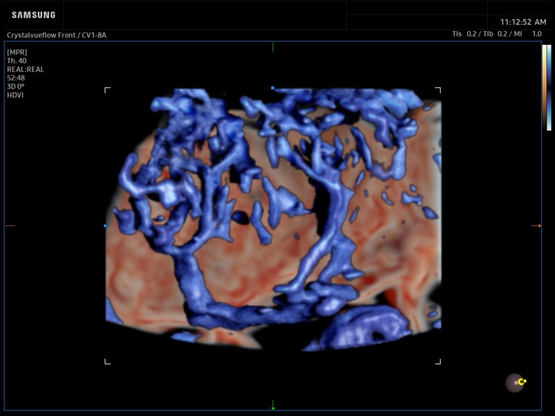 Placenta, CrystalVue & MV-Flow, 3D (echogramm №941)