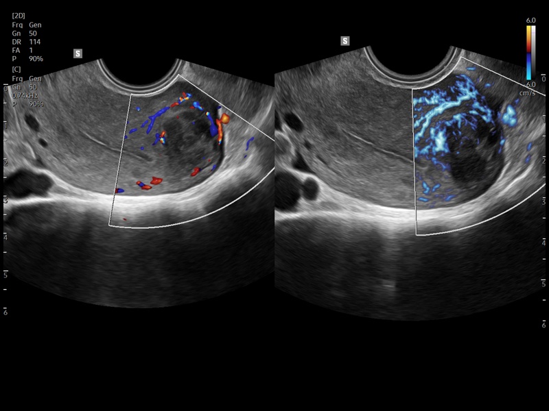 Uterine fibroids, CFM & MV-Flow (echogramm №942)